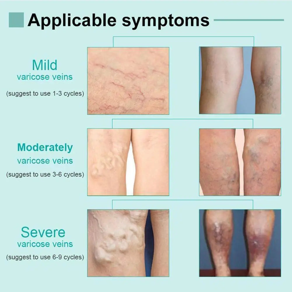Spataderlampenkap Therapy Effective Improve Blood Circulation Relieve Varicose Veins Vasculitis Leg Flebitis Care Products Daily