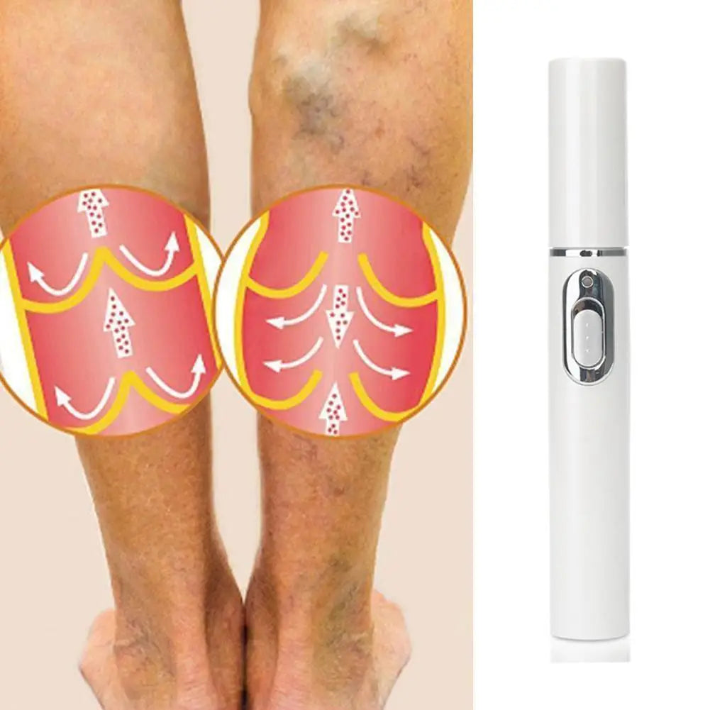 Spataderlampenkap Therapy Effective Improve Blood Circulation Relieve Varicose Veins Vasculitis Leg Flebitis Care Products Daily