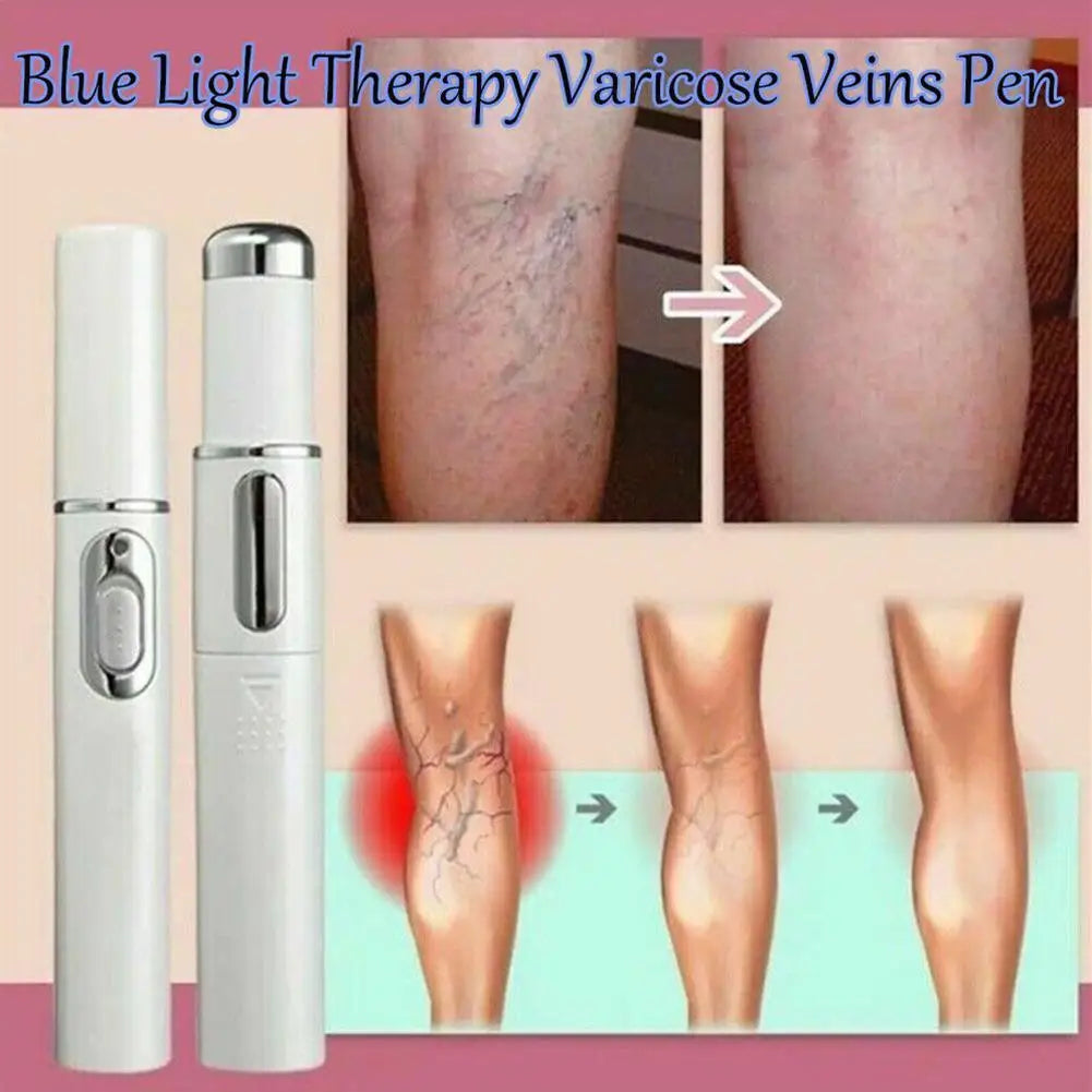 Spataderlampenkap Therapy Effective Improve Blood Circulation Relieve Varicose Veins Vasculitis Leg Flebitis Care Products Daily