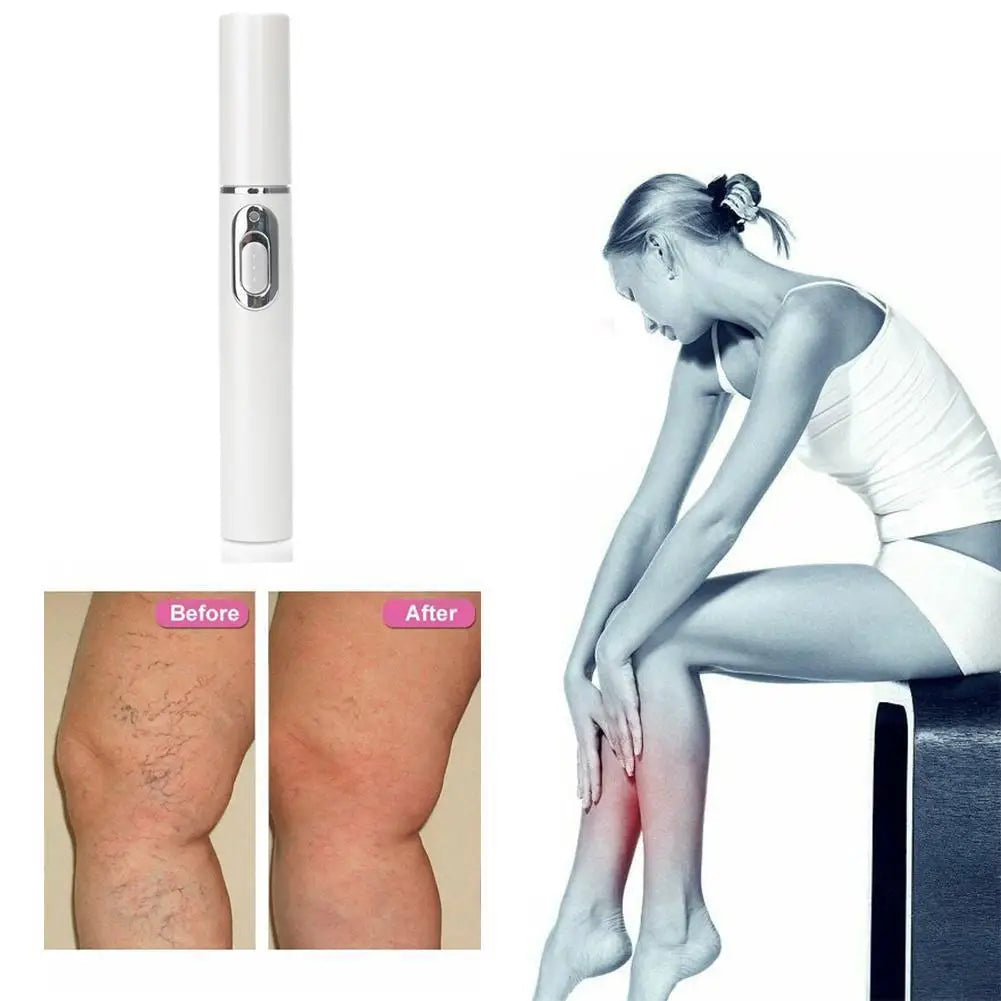 Spataderlampenkap Therapy Effective Improve Blood Circulation Relieve Varicose Veins Vasculitis Leg Flebitis Care Products Daily