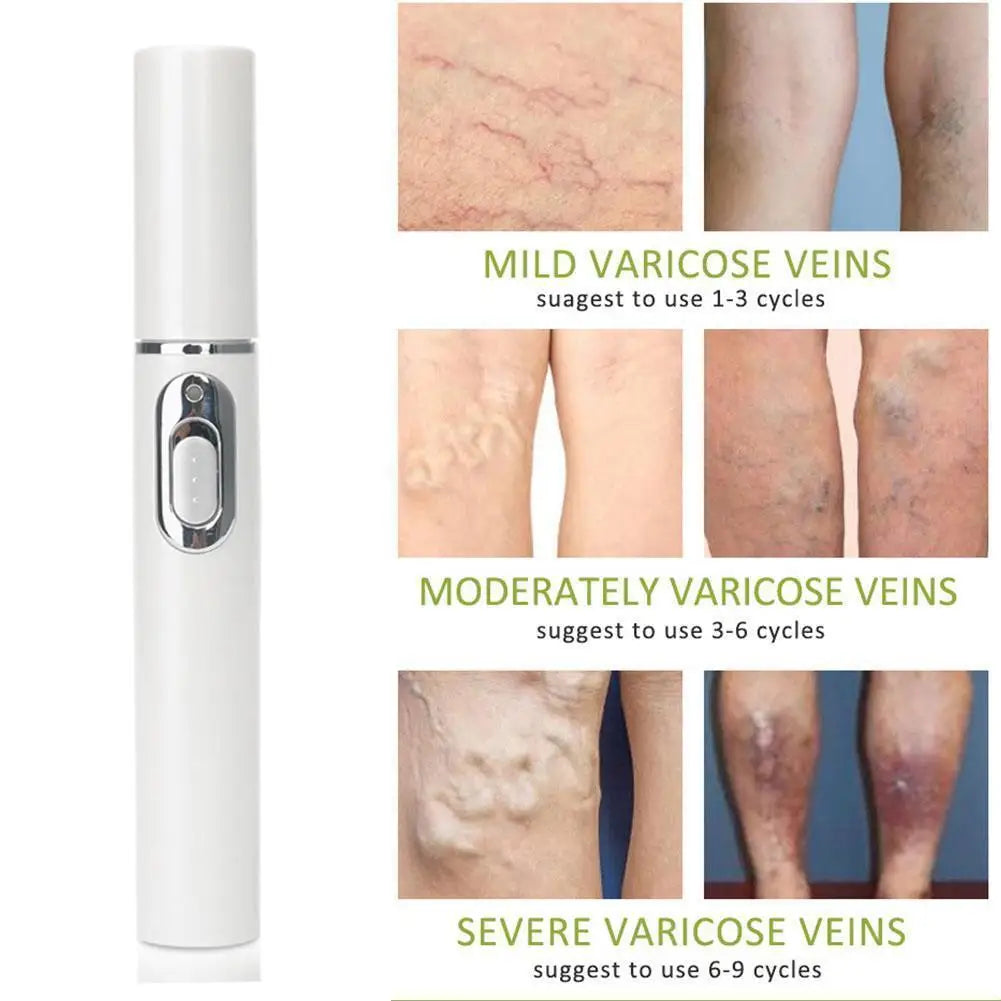 Spataderlampenkap Therapy Effective Improve Blood Circulation Relieve Varicose Veins Vasculitis Leg Flebitis Care Products Daily